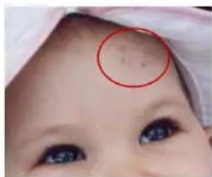 Close-up of a baby's face with a red circle highlighting the eyebrow area (no text or symbols visible)