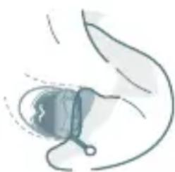 Illustration of a medical device with a bulb and clamped parts, no text or symbols present