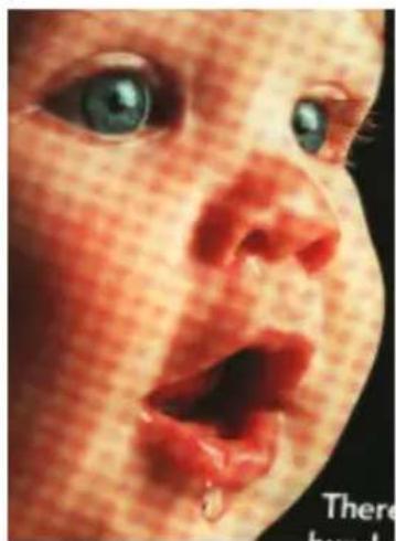 Close-up of a baby's face showing redness and absorption, with no visible text or symbols