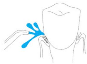 Simple line drawing of a tooth with a blue arrow pointing to the base (no text or symbols)